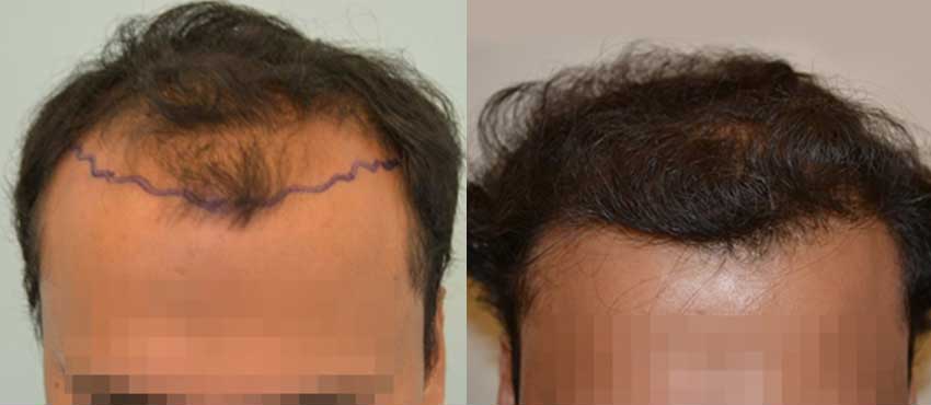 DHI before & after hair transplant results