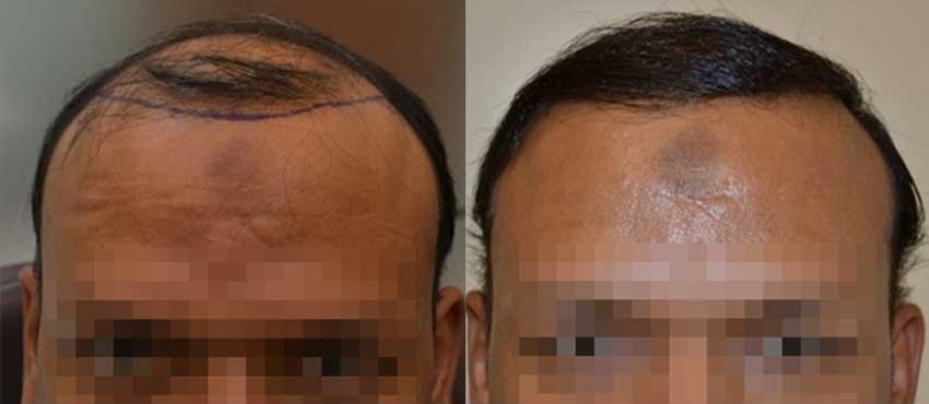 DHI before & after hair transplant results