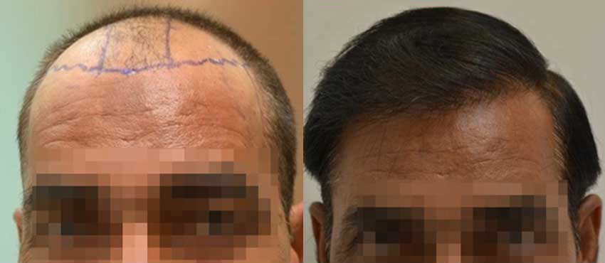 DHI before & after hair transplant results