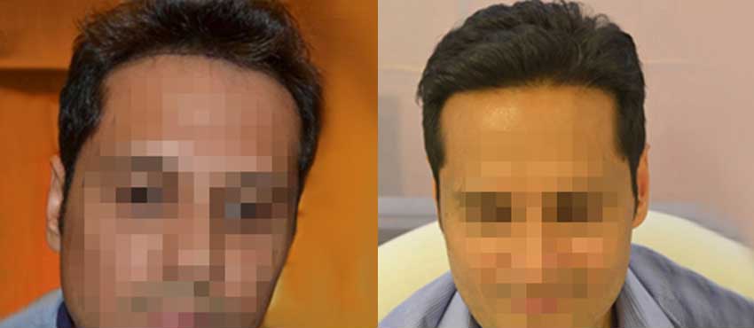 DHI before & after hair transplant results