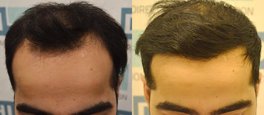 DHI before & after hair transplant results