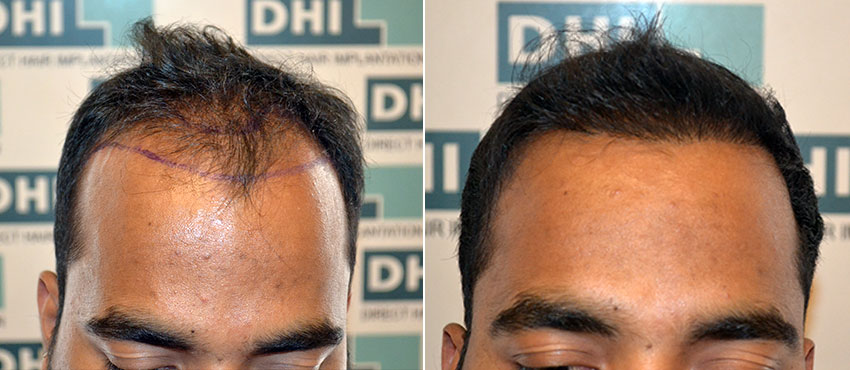 DHI before & after hair transplant results