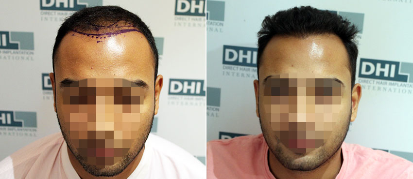 DHI before & after hair transplant results