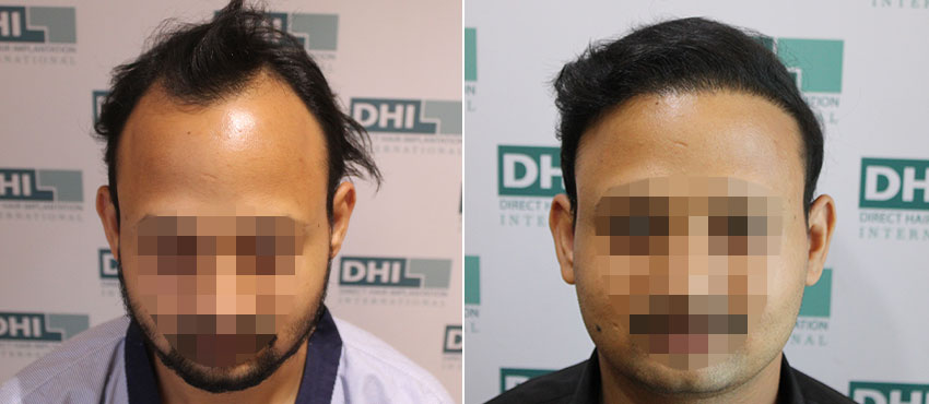 DHI before & after hair transplant results