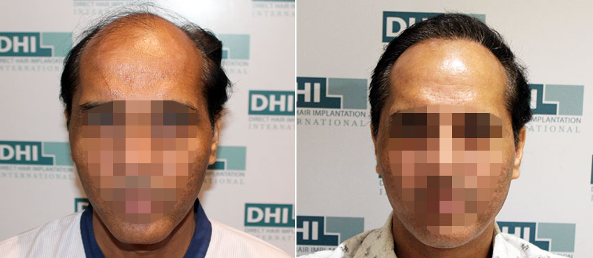 DHI before & after hair transplant results