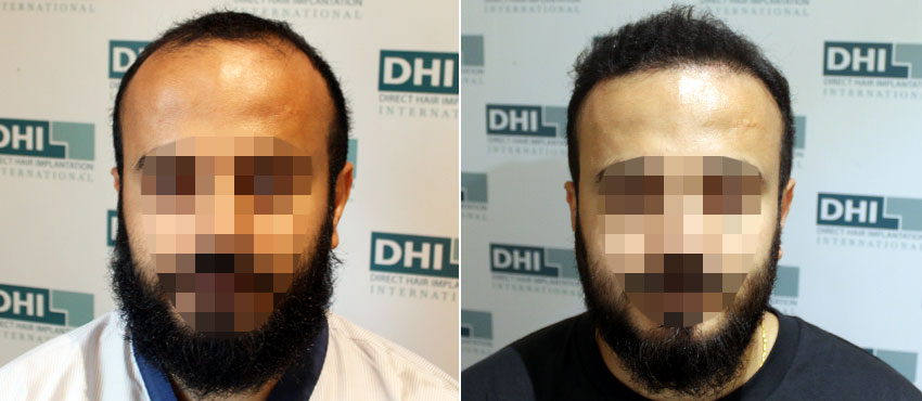 DHI before & after hair transplant results