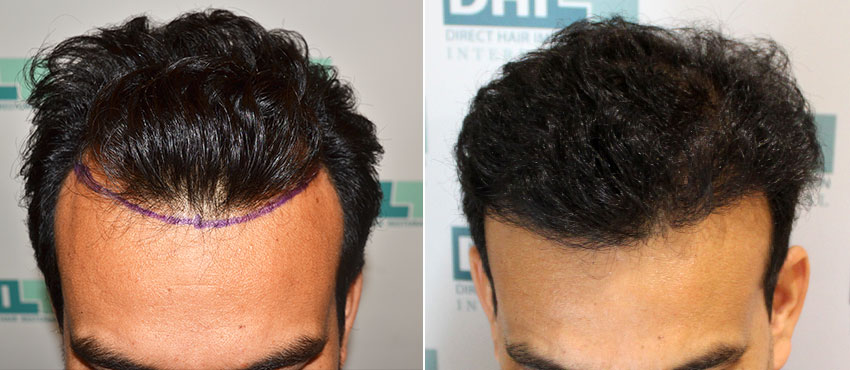 DHI before & after hair transplant results