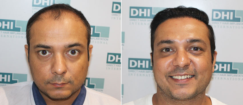 DHI before & after hair transplant results