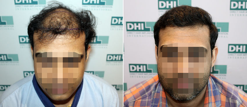 DHI before & after hair transplant results