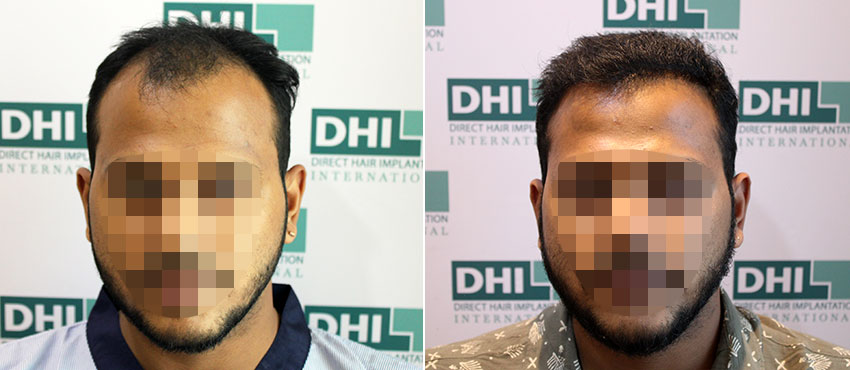 DHI before & after hair transplant results