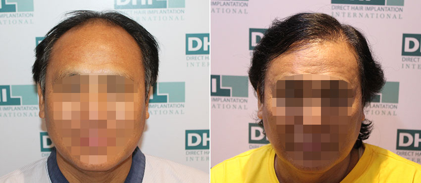 DHI before & after hair transplant results