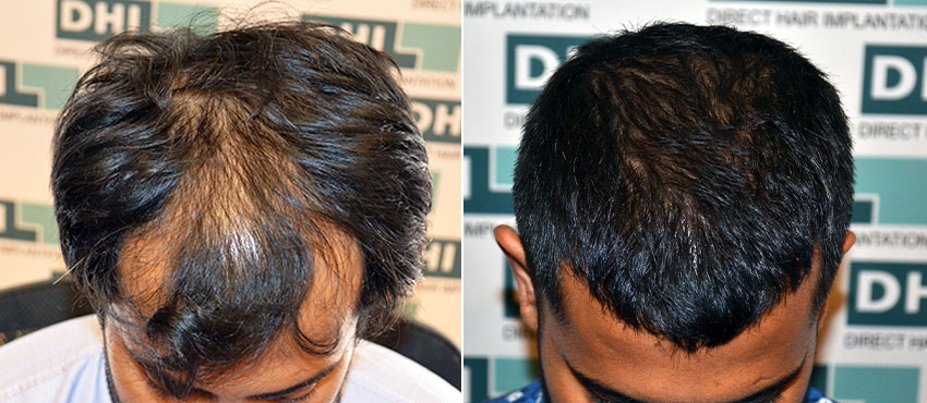 DHI before & after hair transplant results