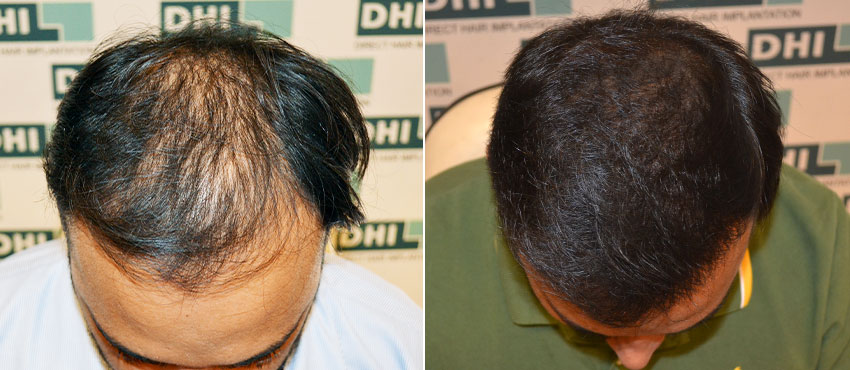 DHI before & after hair transplant results