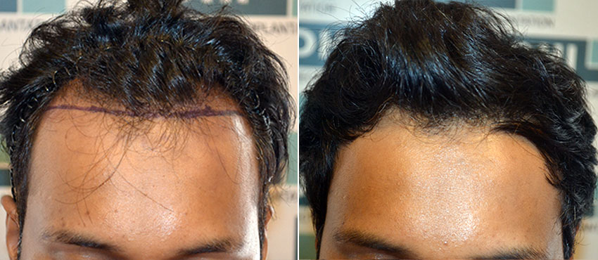 DHI before & after hair transplant results