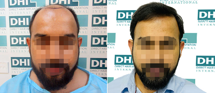 DHI before & after hair transplant results