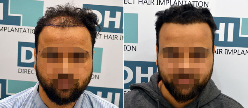 DHI before & after hair transplant results