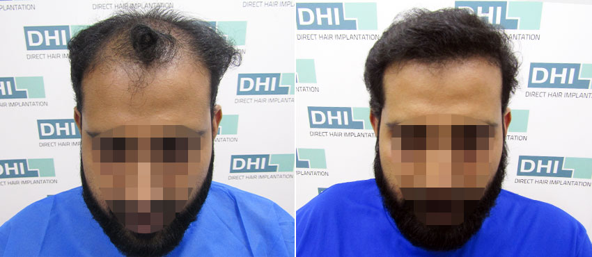 DHI before & after hair transplant results