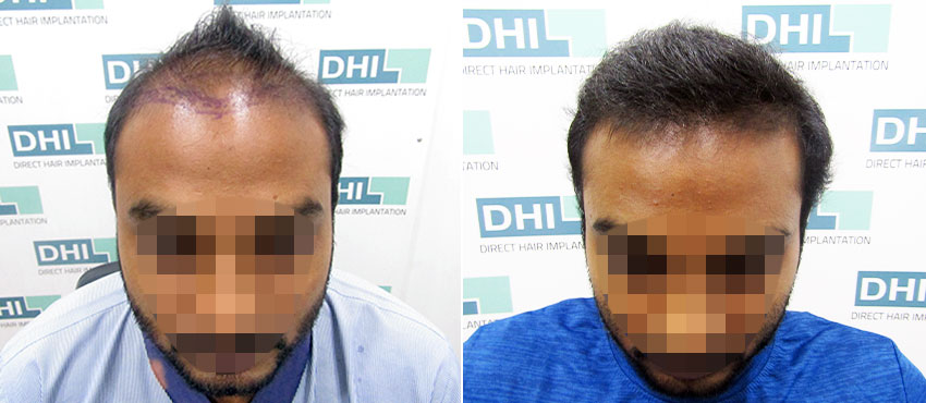 DHI before & after hair transplant results