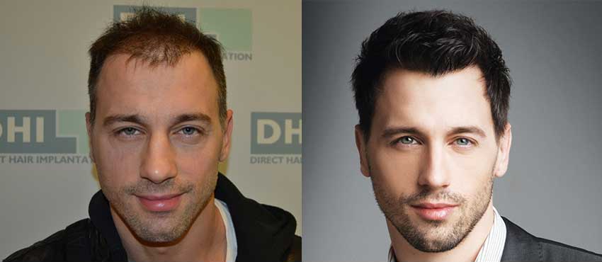 Vladimir Cvetkovic before and after