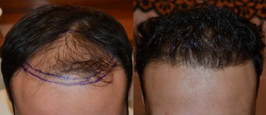 DHI before & after hair transplant results