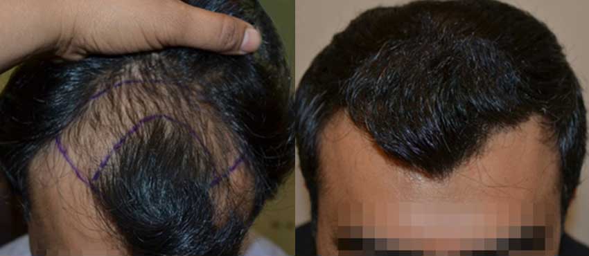 DHI before & after hair transplant results