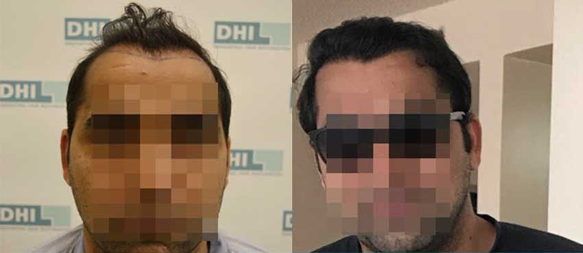 DHI before & after hair transplant results