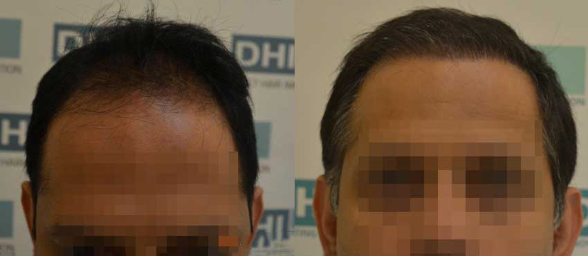 DHI before & after hair transplant results