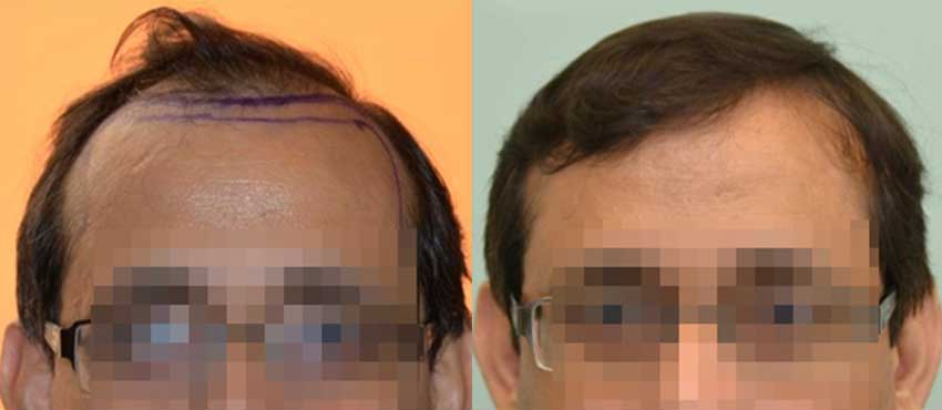 DHI before & after hair transplant results