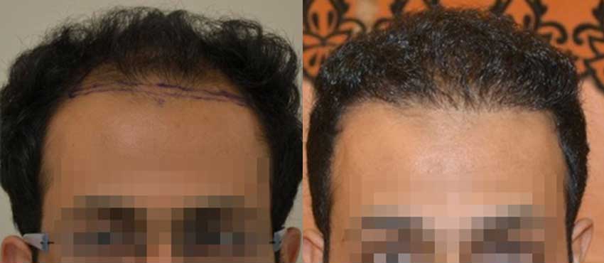 DHI before & after hair transplant results