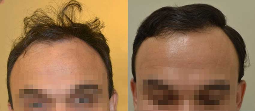 DHI before & after hair transplant results