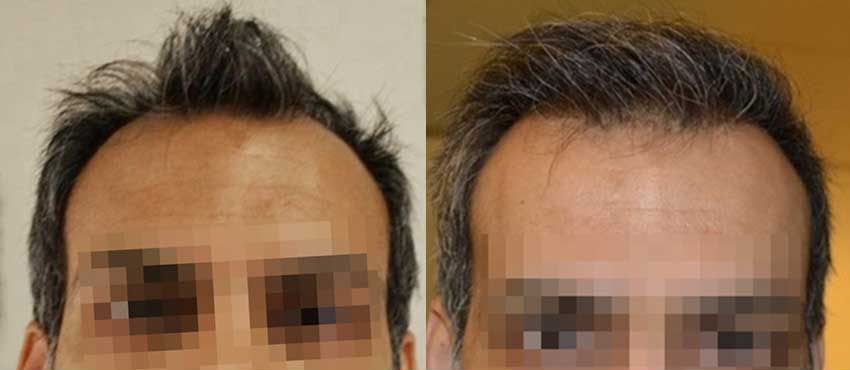 DHI before & after hair transplant results