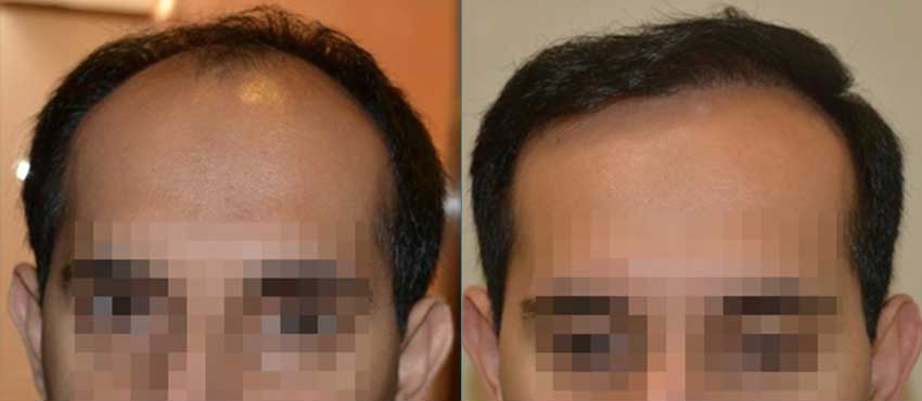 DHI before & after hair transplant results