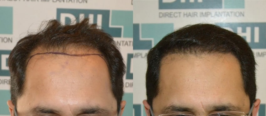 DHI before & after hair transplant results