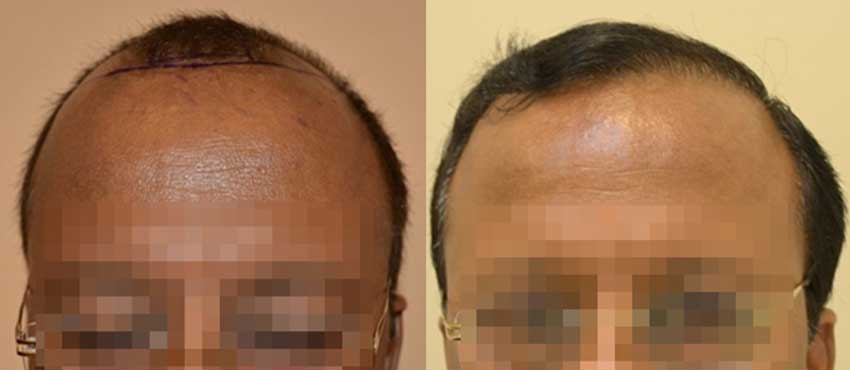 DHI before & after hair transplant results