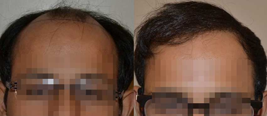 DHI before & after hair transplant results