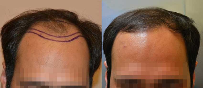 DHI before & after hair transplant results