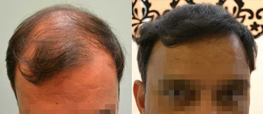 DHI before & after hair transplant results