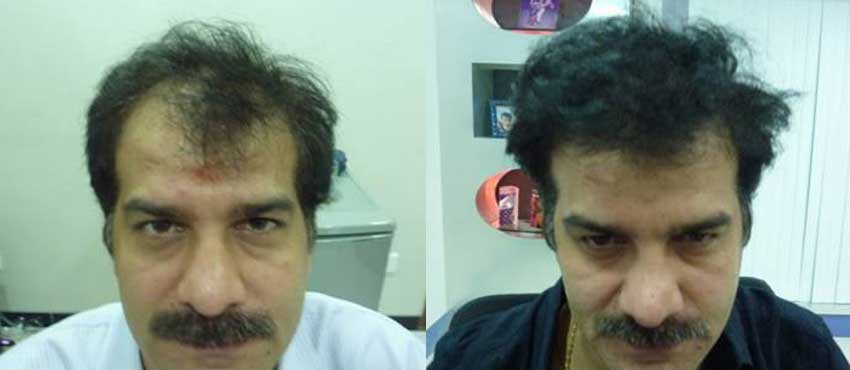 DHI before & after hair transplant results