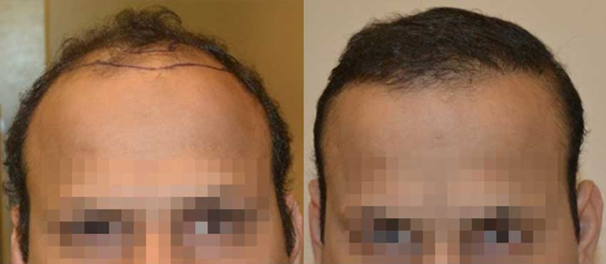 DHI before & after hair transplant results