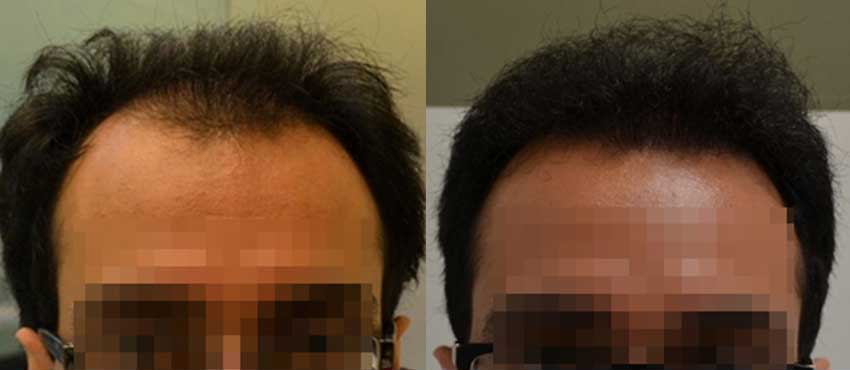 DHI before & after hair transplant results