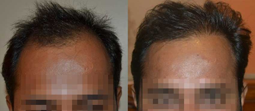 DHI before & after hair transplant results