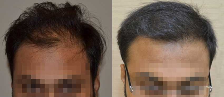 DHI before & after hair transplant results