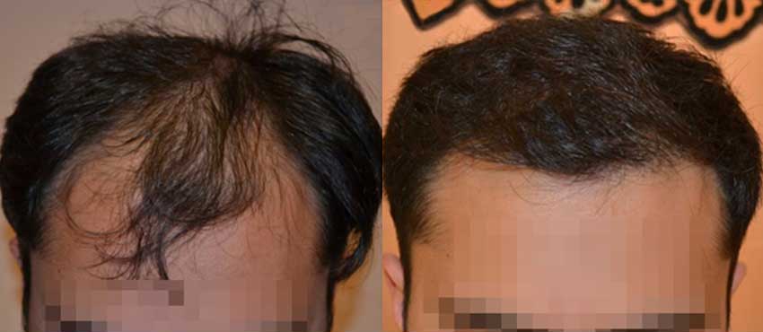 DHI before & after hair transplant results