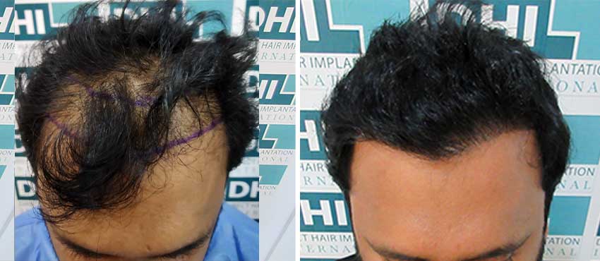 DHI before & after hair transplant results