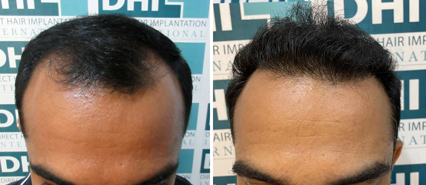 DHI before & after hair transplant results