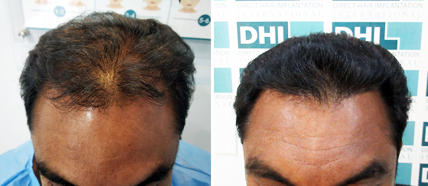 DHI before & after hair transplant results