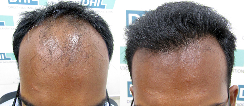 DHI before & after hair transplant results