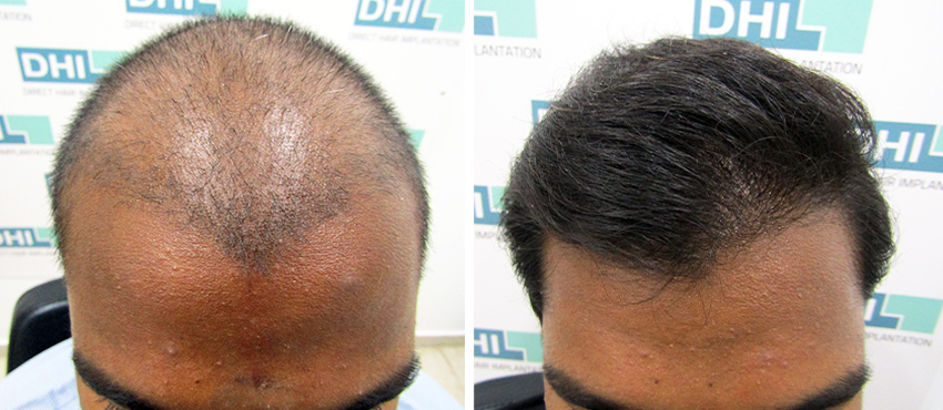 DHI before & after hair transplant results