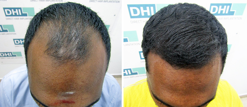 DHI before & after hair transplant results