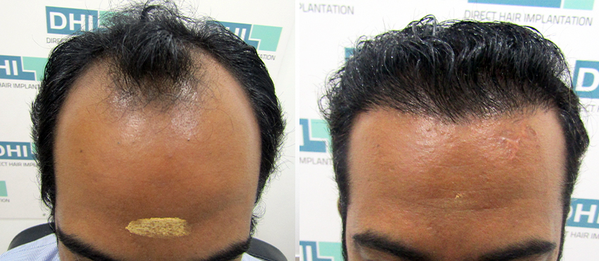 DHI before & after hair transplant results